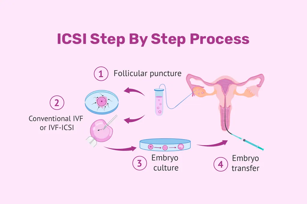 ICSI treatment