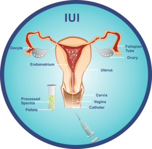 IUI treatment
